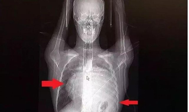 Tıbbi Mucize İstanbul'da Gerçekleşti: 12 cm Kayan Kalbe Doktor Müdahalesi!